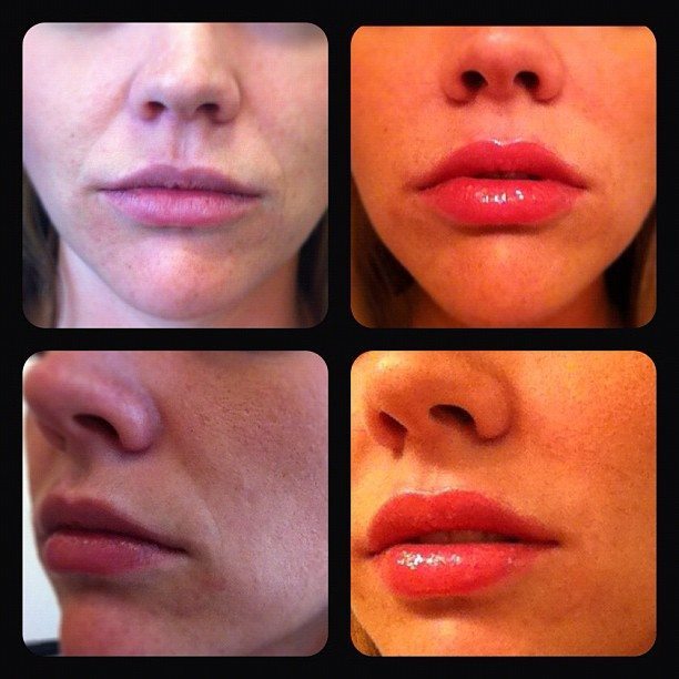 Before and Dr. Rose used BeloTero dermal filler to treat smile lines.