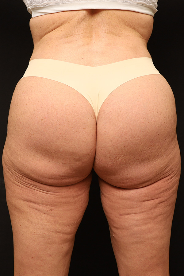 Brazilian Butt Lift Before and After 01