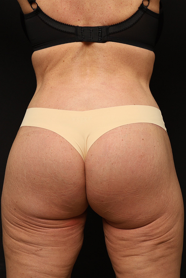 Brazilian Butt Lift Before and After 07