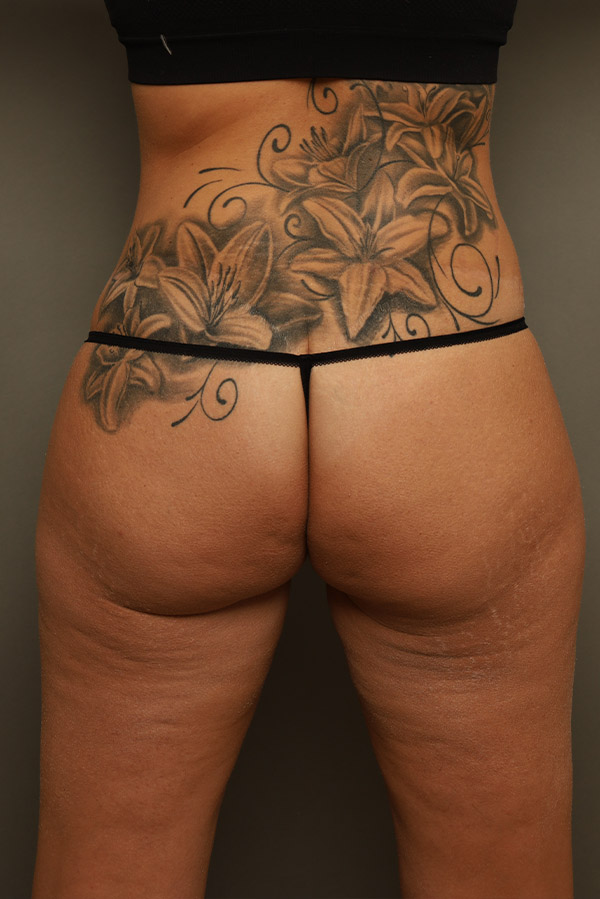 Brazilian Butt Lift Before and After 02