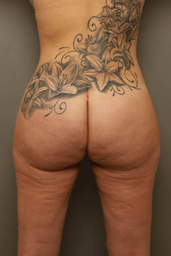 Brazilian Butt Lift Before and After 07