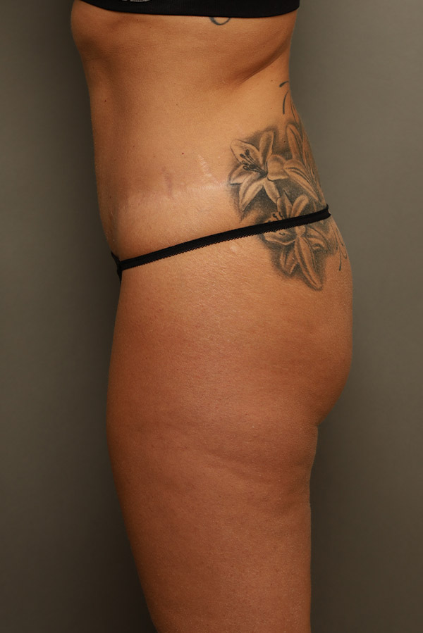 Brazilian Butt Lift Before and After 02