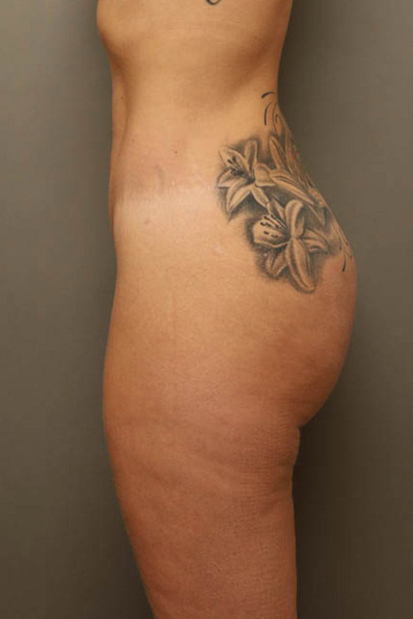 Brazilian Butt Lift Before and After 02