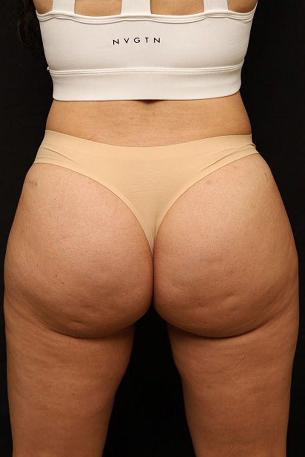 Brazilian Butt Lift Before and After 07