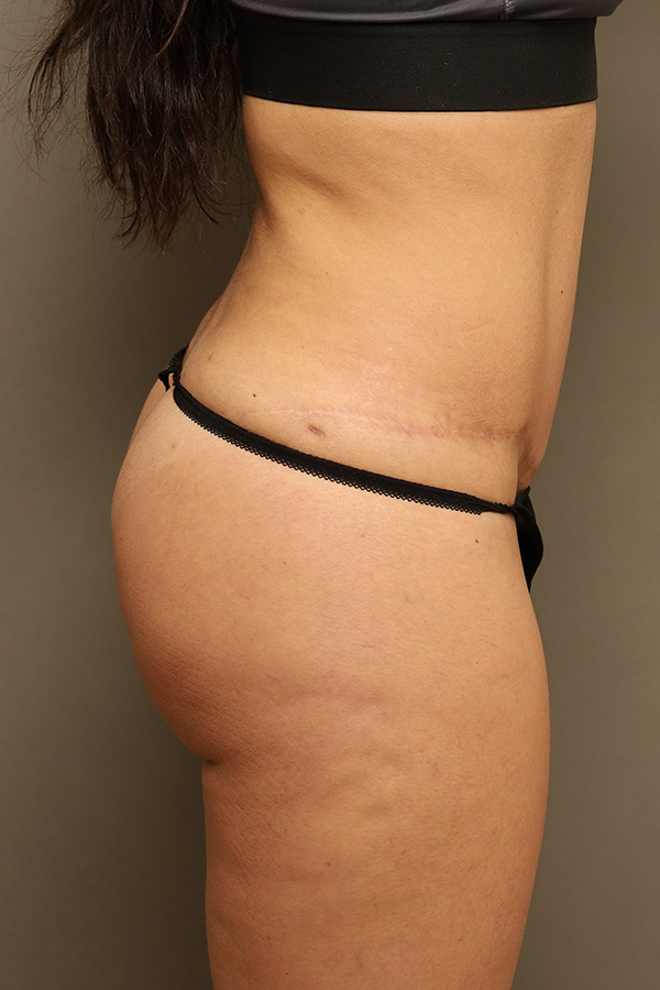 Brazilian Butt Lift Before and After 03