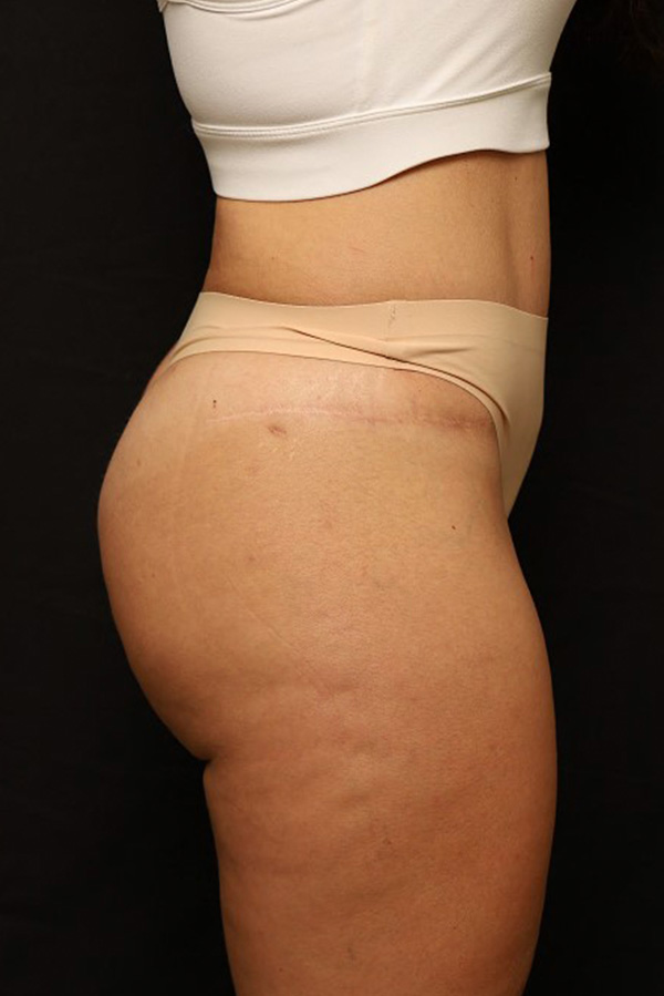 Brazilian Butt Lift Before and After 03