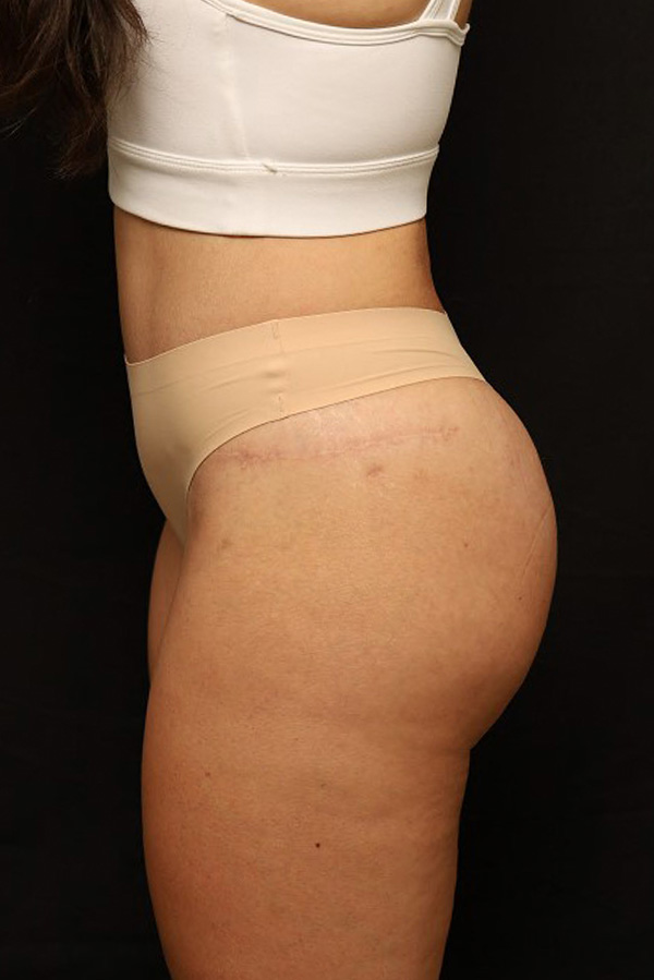 Brazilian Butt Lift Before and After 03