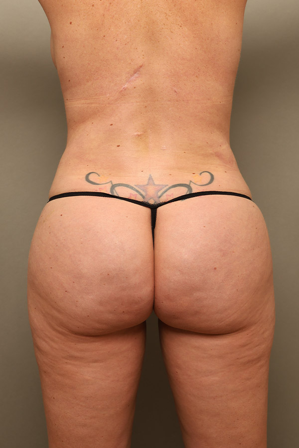 Brazilian Butt Lift Before and After 07