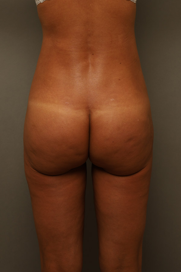 Brazilian Butt Lift Before and After 07