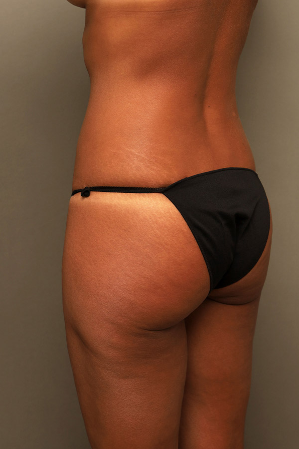 Brazilian Butt Lift Before and After 05