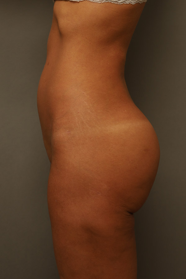 Brazilian Butt Lift Before and After 05