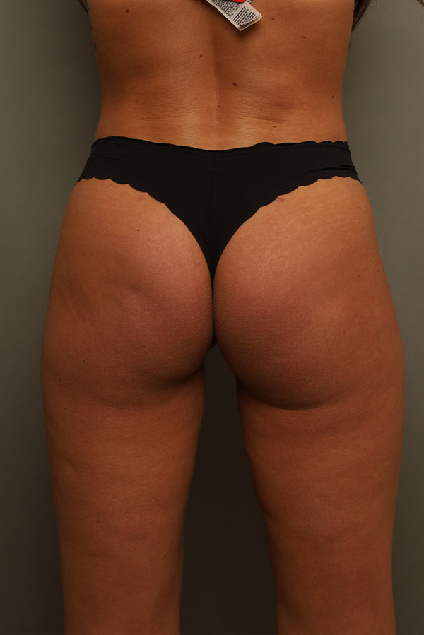 Brazilian Butt Lift Before and After 07