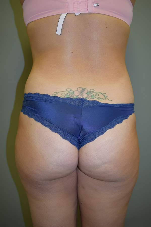 Brazilian Butt Lift Before and After 07