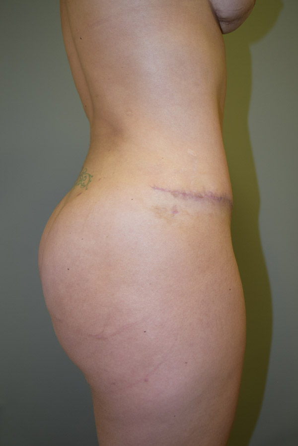 Brazilian Butt Lift Before and After 07