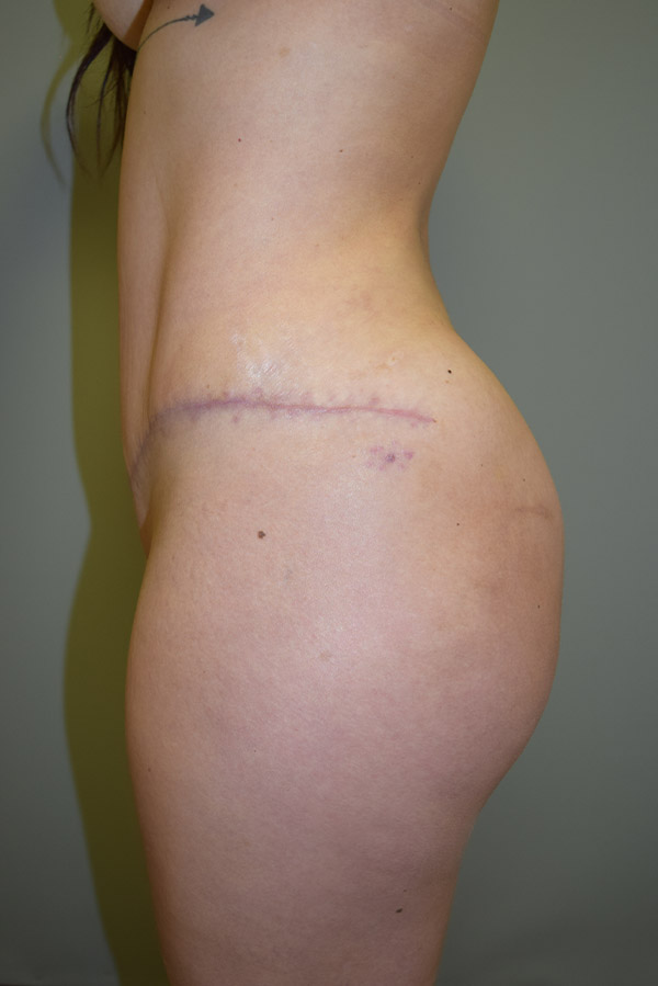 Brazilian Butt Lift Before and After 07