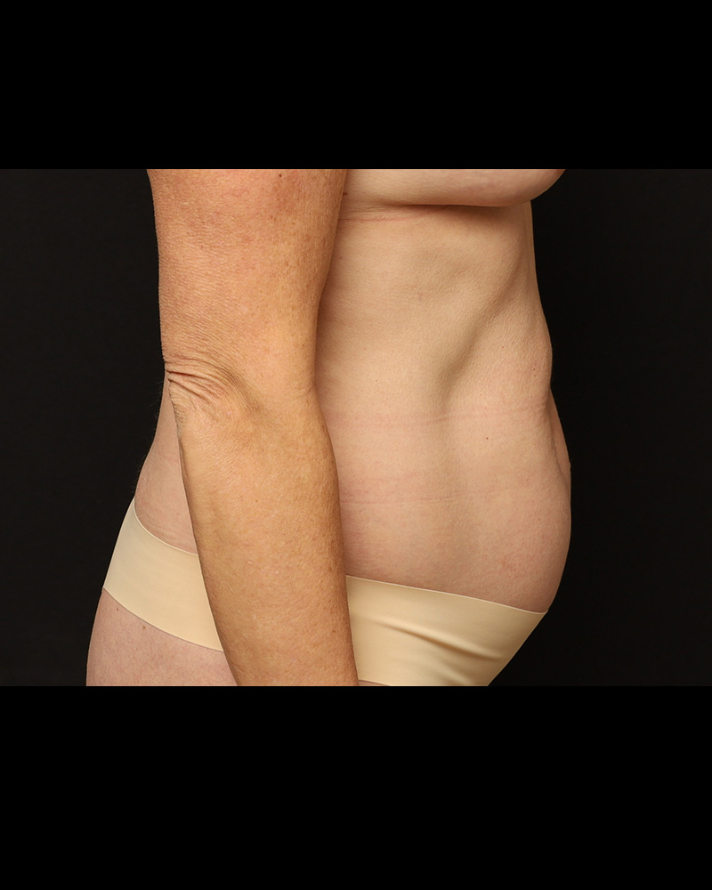 Liposuction Before and After 01