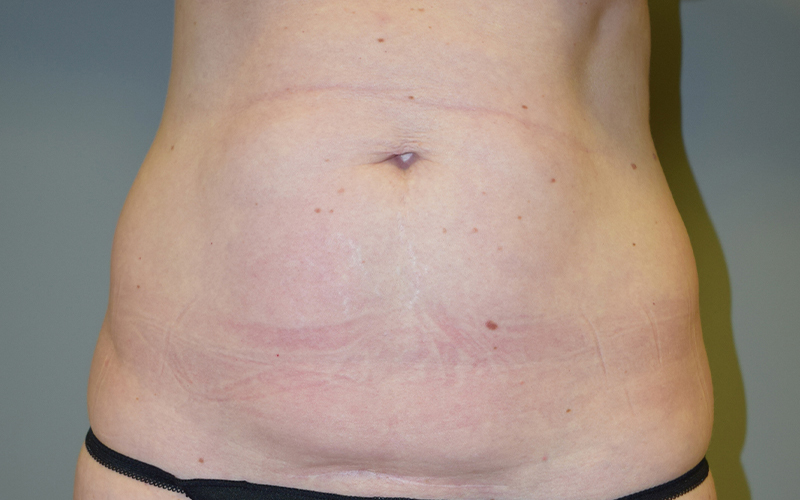 Mini Tummy Tuck Before and After 01