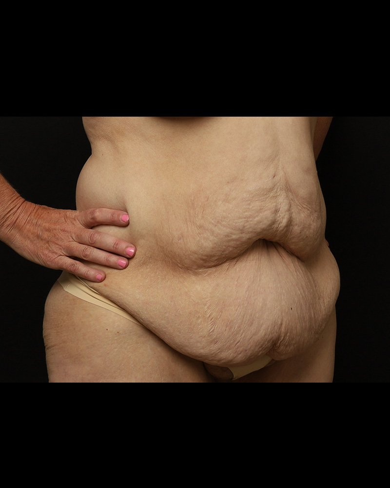 Tummy Tuck Before and After 01