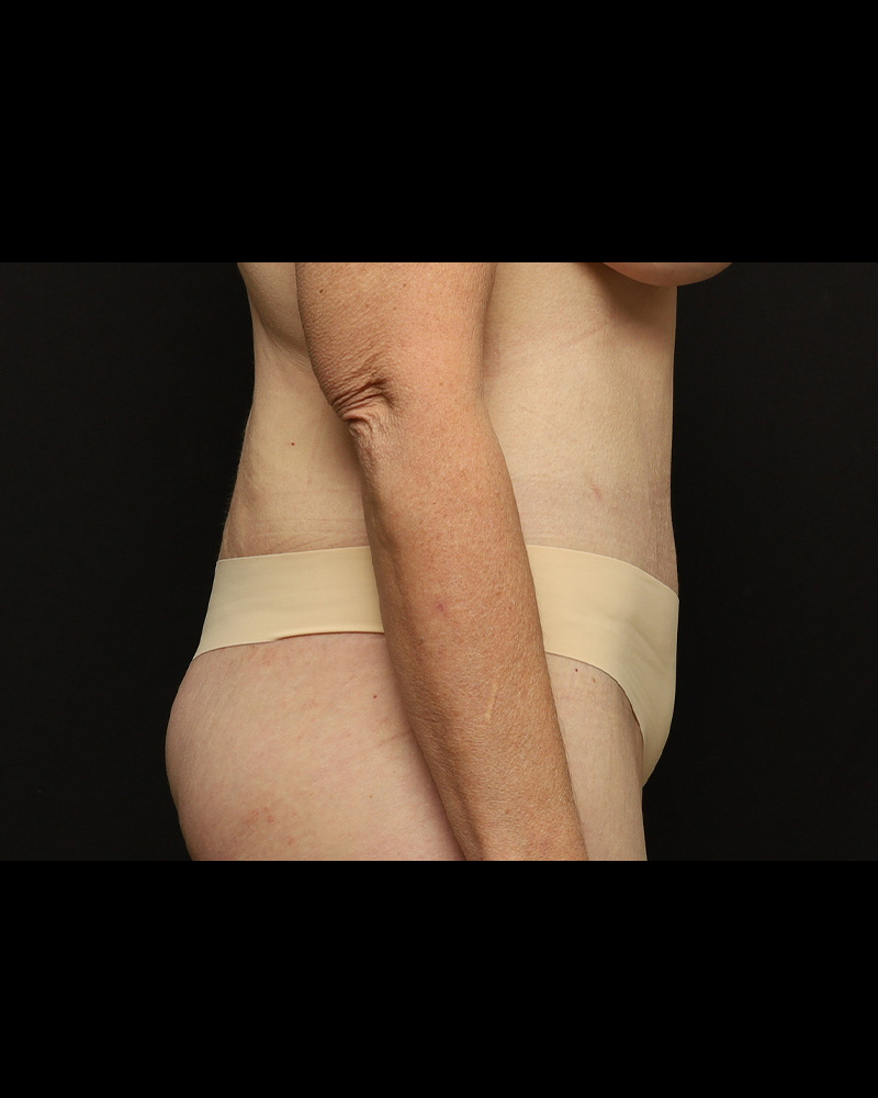 Tummy Tuck Before and After 01