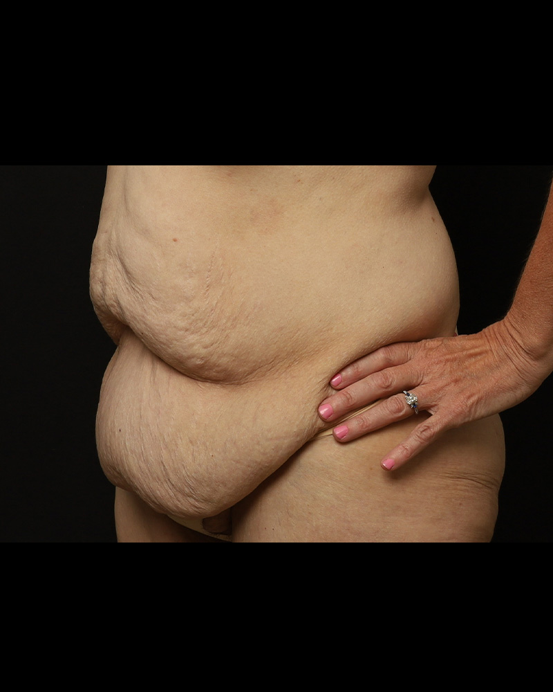 Tummy Tuck Before and After 01
