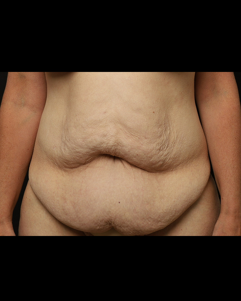 Tummy Tuck Before and After 01