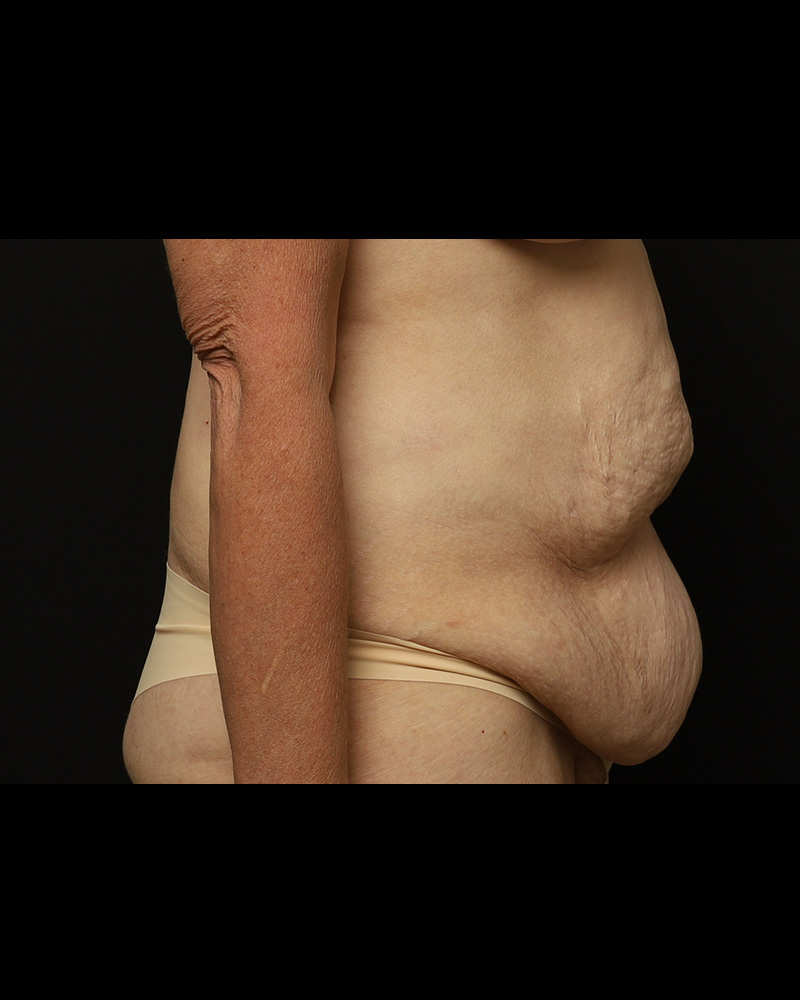 Tummy Tuck Before and After 01