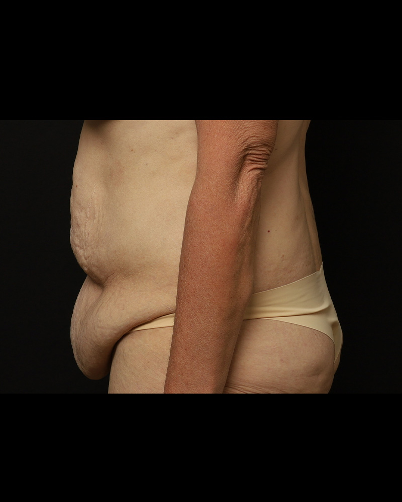 Tummy Tuck Before and After 01