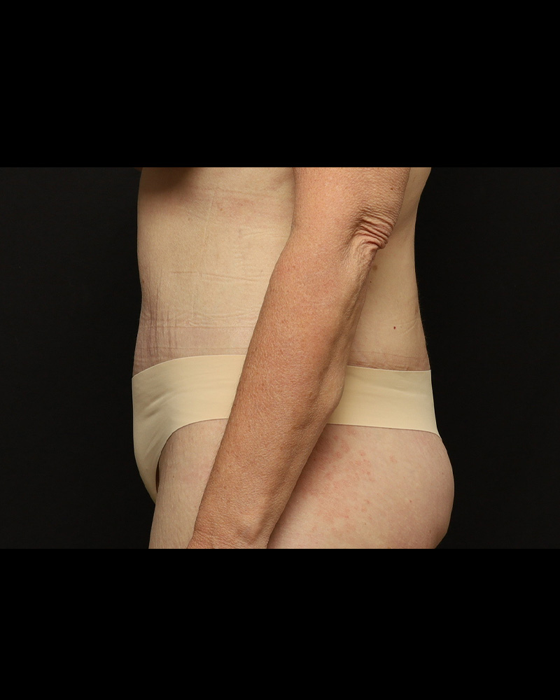 Tummy Tuck Before and After 01