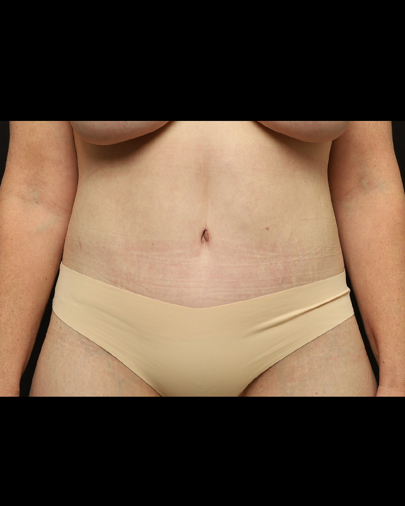 Tummy Tuck Before and After 01