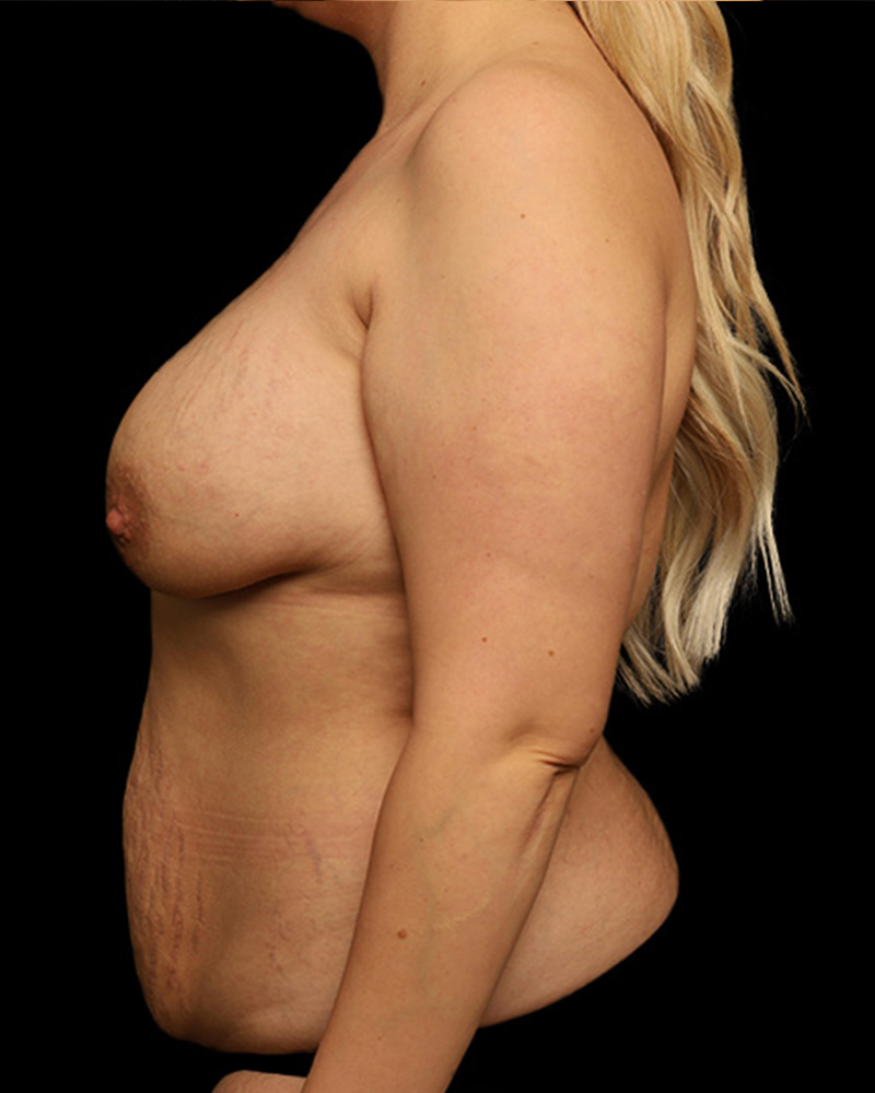 Mommy Makeover Before and After 18