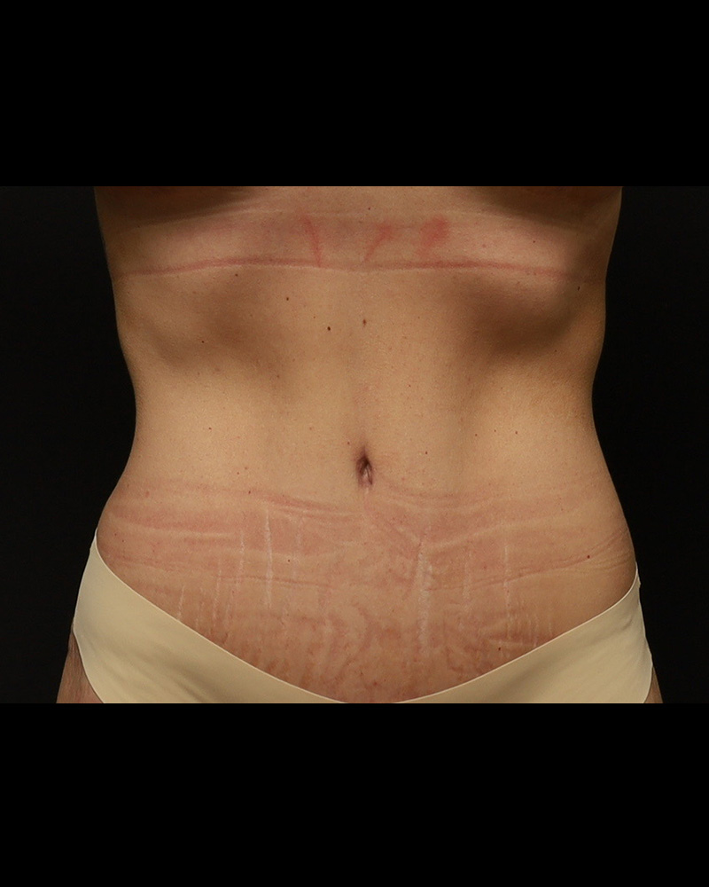 Tummy Tuck Before and After 07