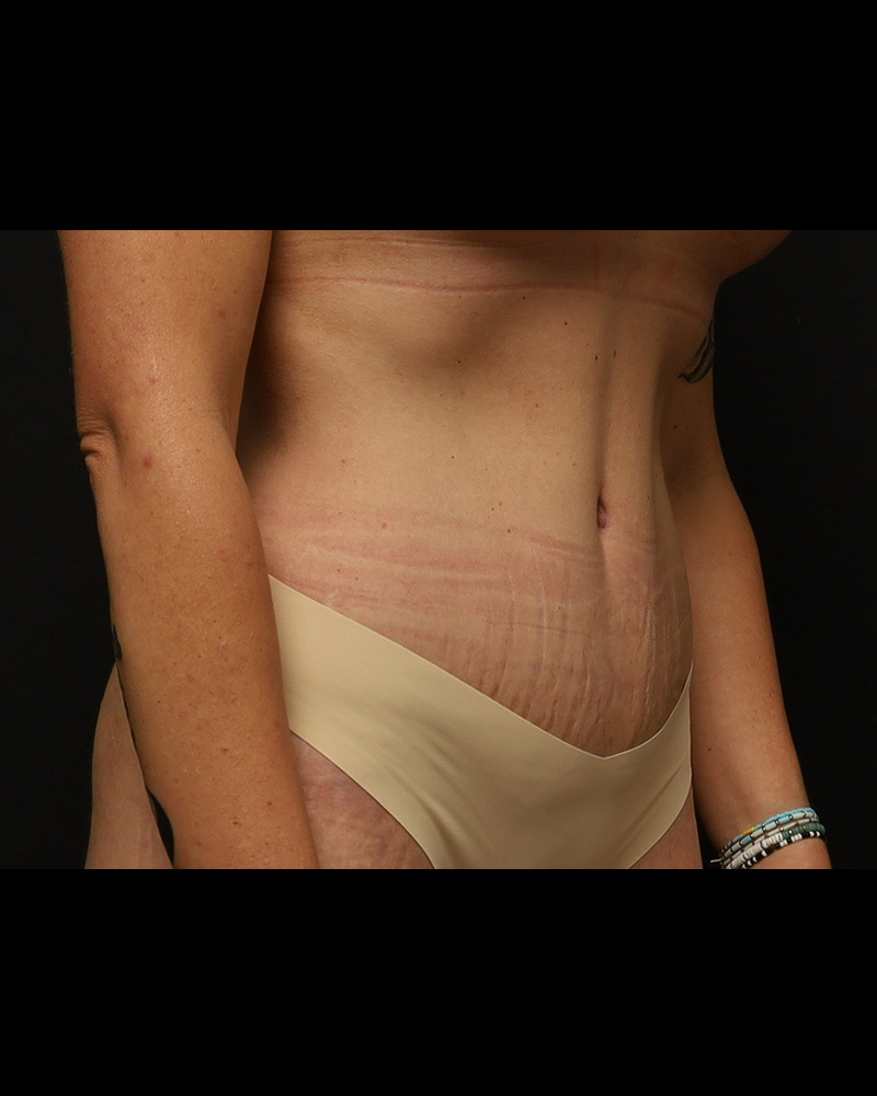 Tummy Tuck Before and After 01