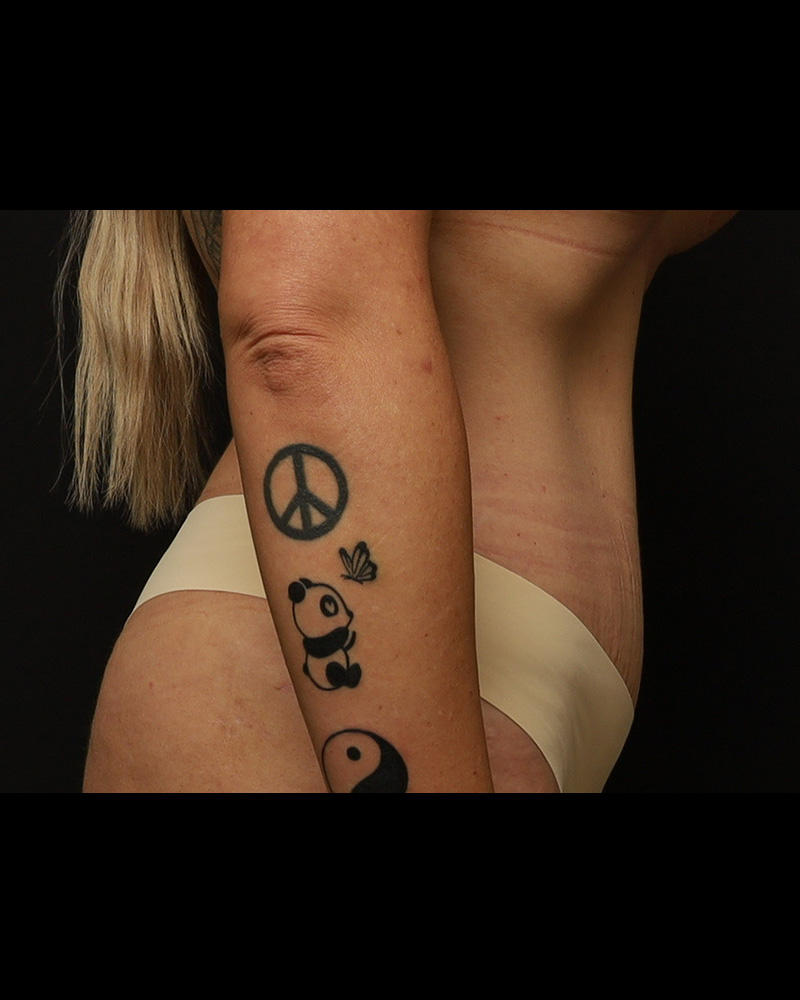 Tummy Tuck Before and After 01