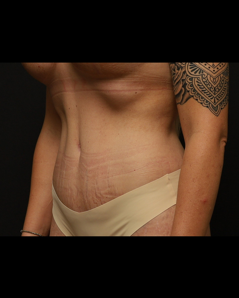 Tummy Tuck Before and After 01