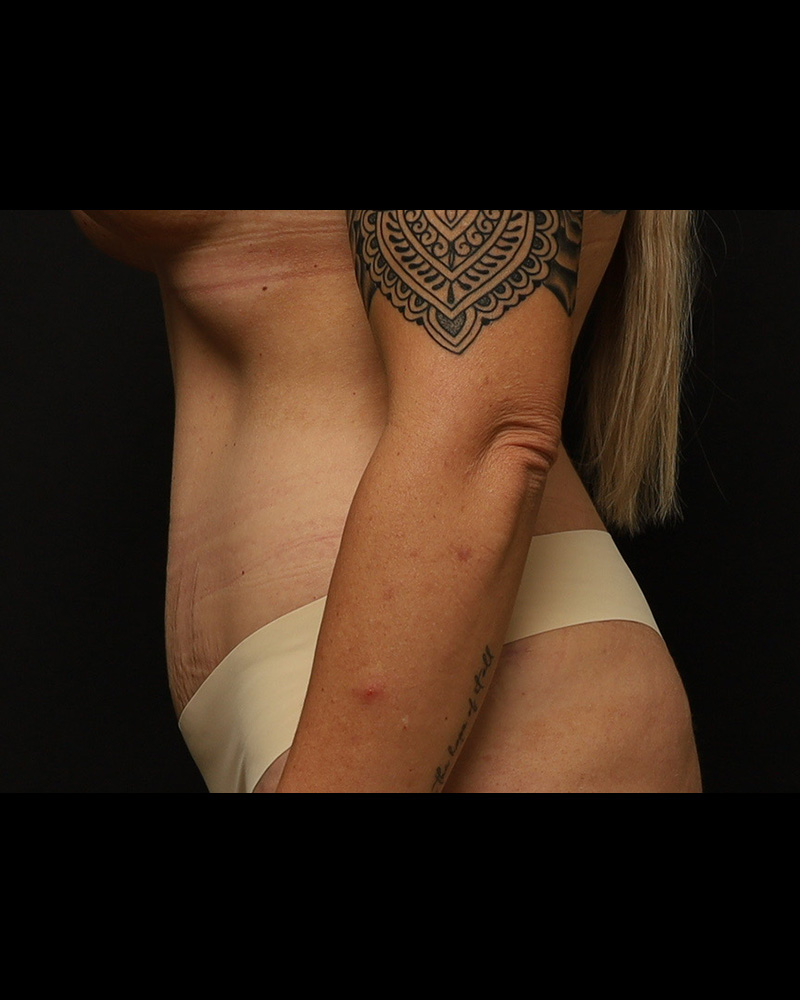 Tummy Tuck Before and After 01