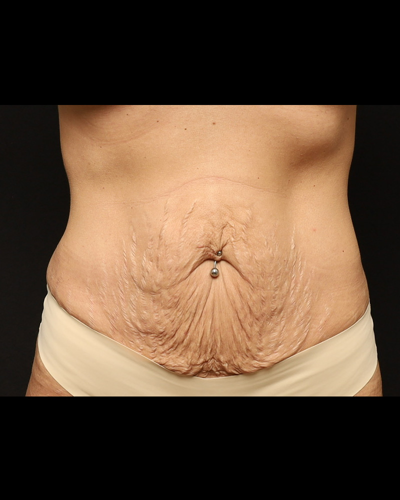 Tummy Tuck Before and After 02