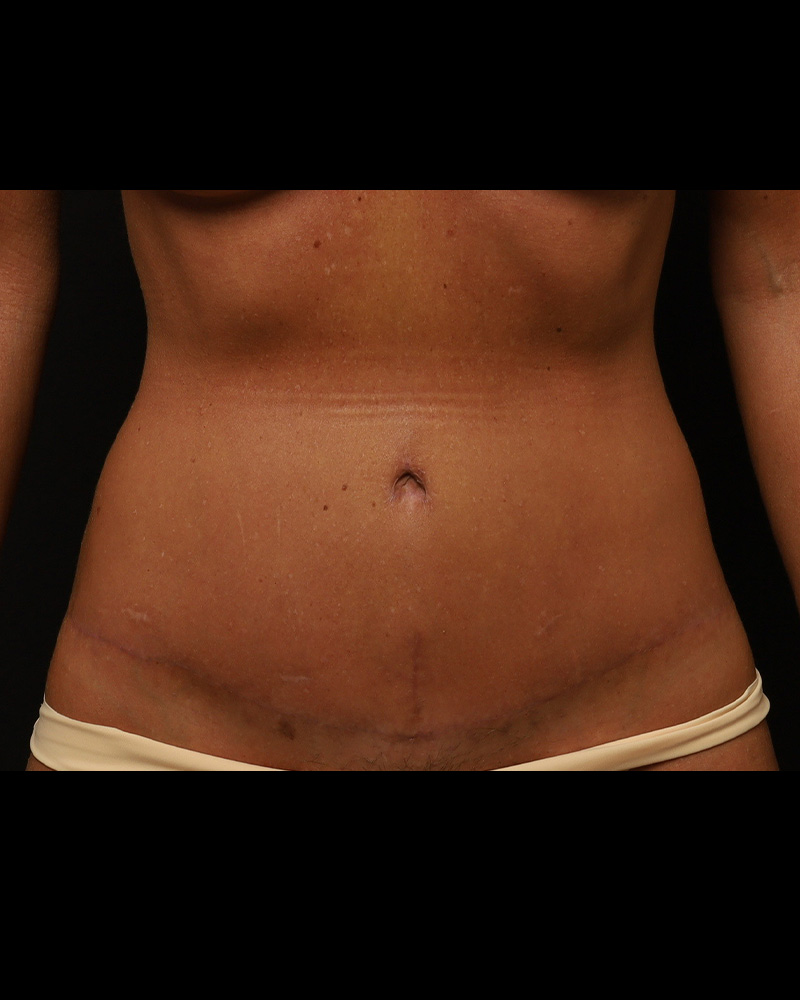 Tummy Tuck Before and After 07