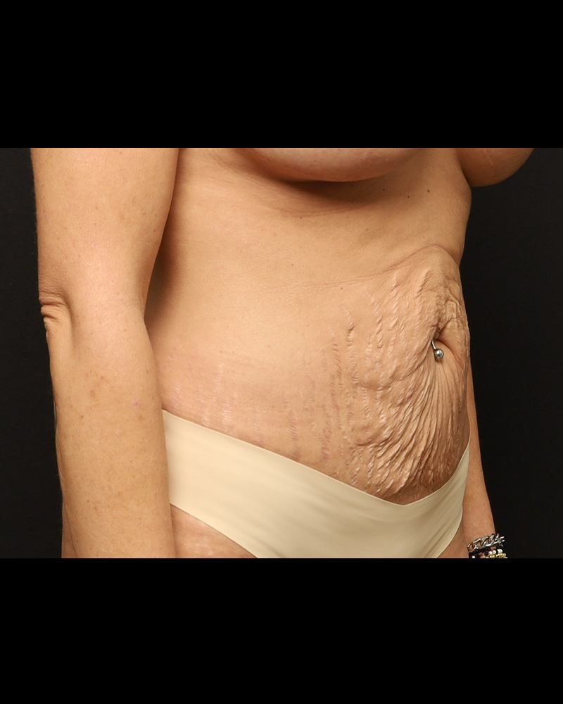 Tummy Tuck Before and After 02