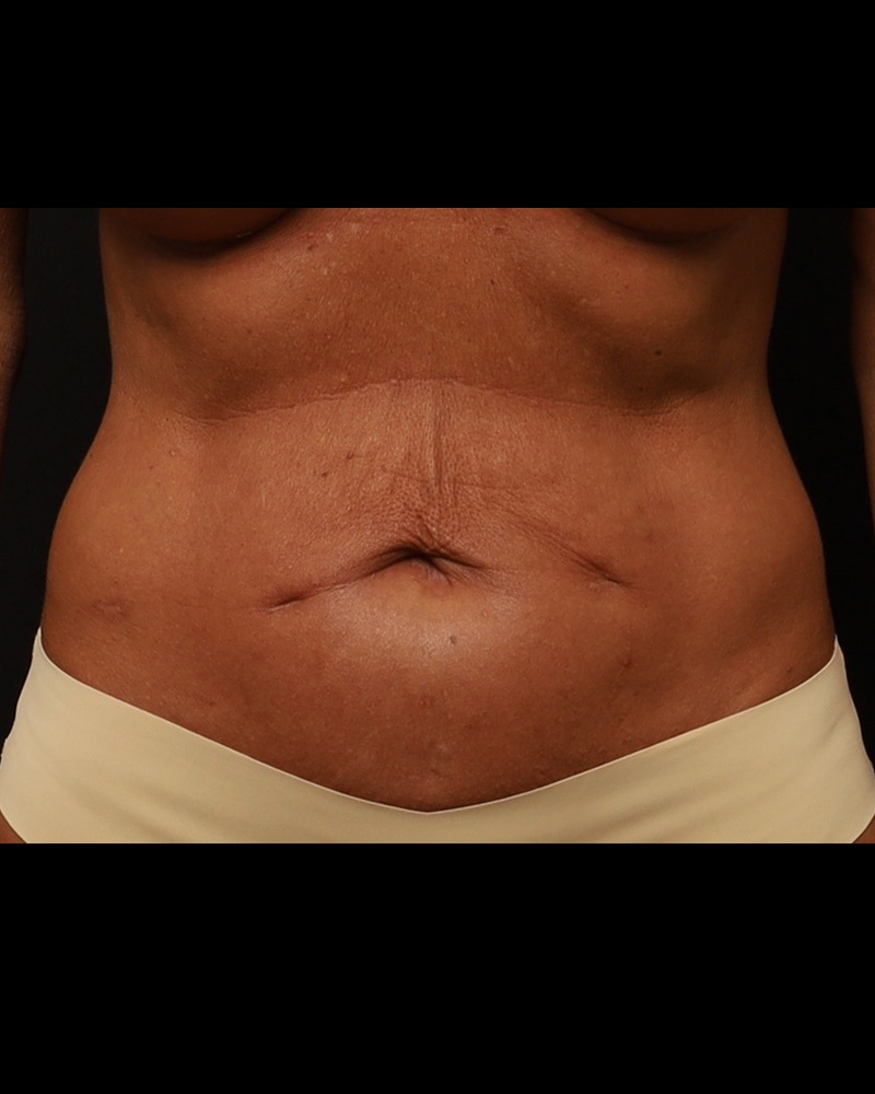 Tummy Tuck Before and After 03