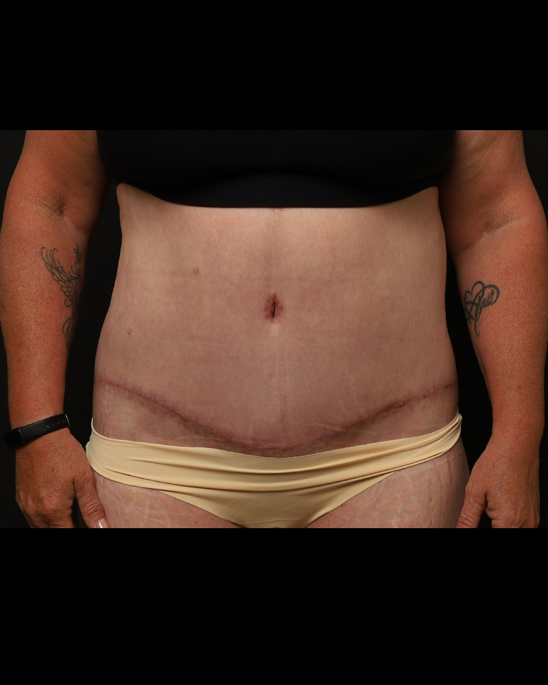 Tummy Tuck Before and After 07