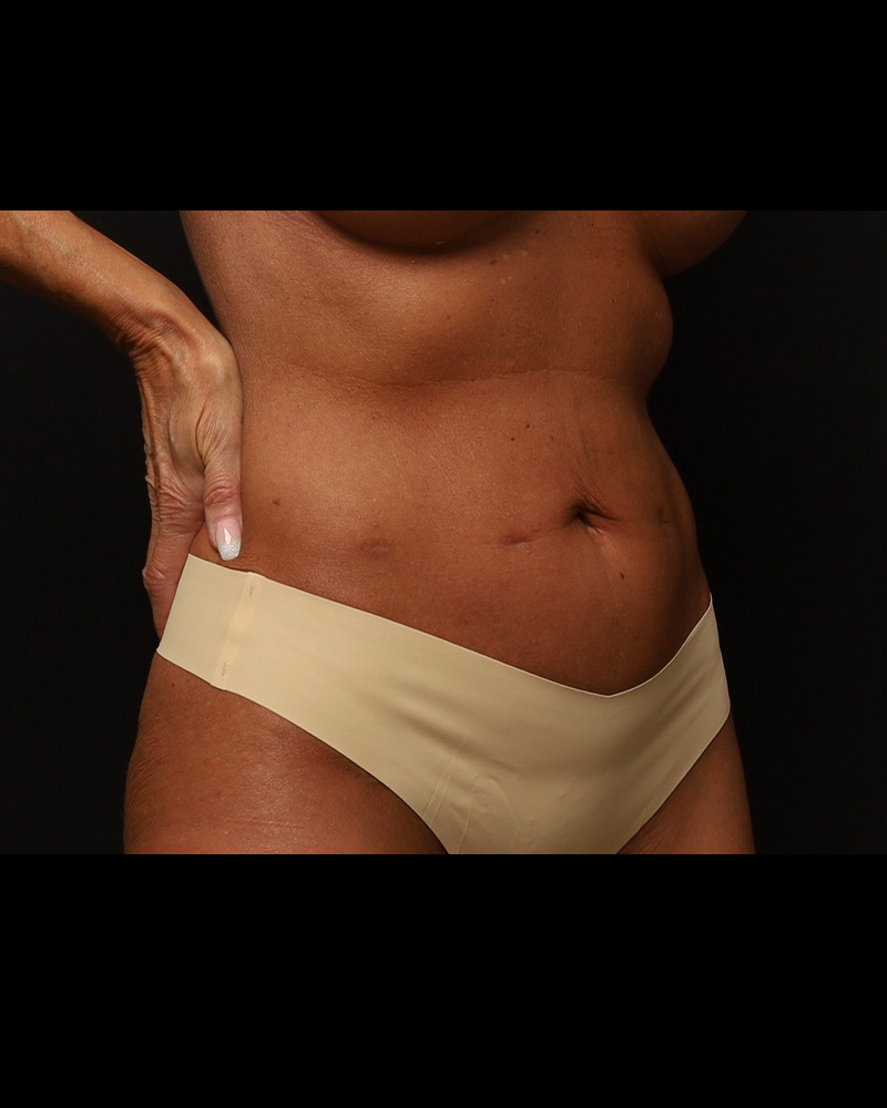 Tummy Tuck Before and After 03