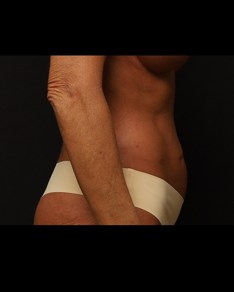 Tummy Tuck Before and After 03