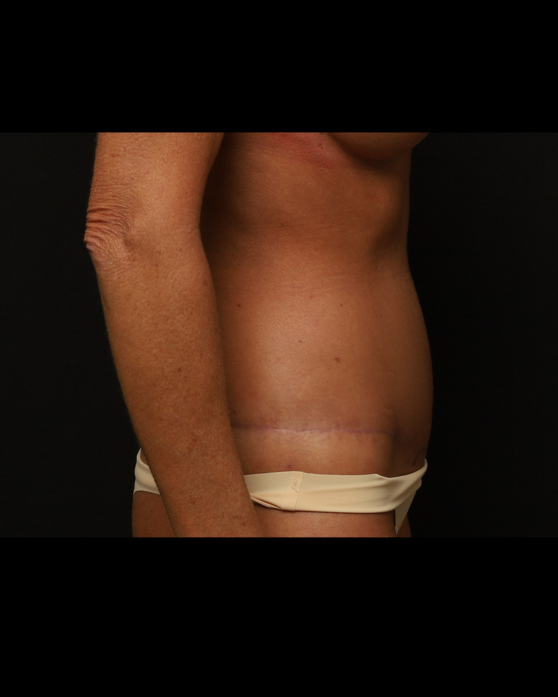 Tummy Tuck Before and After 03