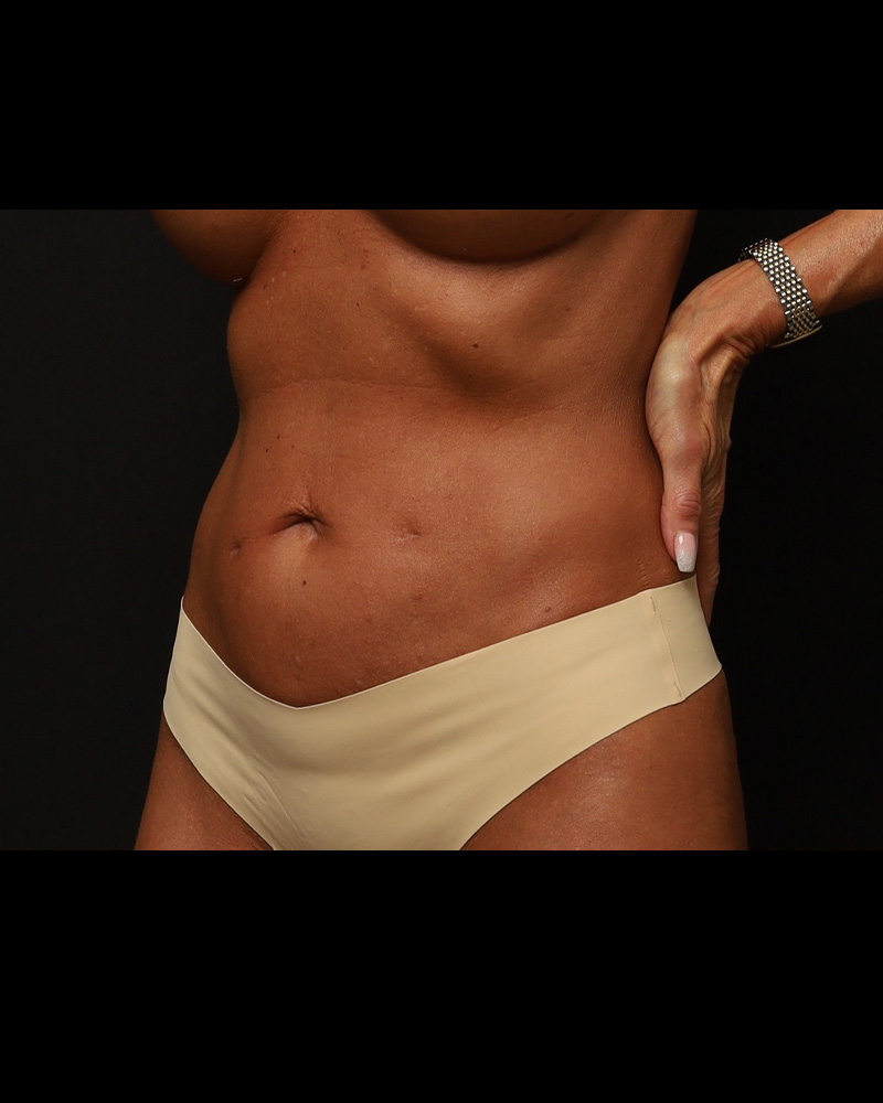 Tummy Tuck Before and After 03