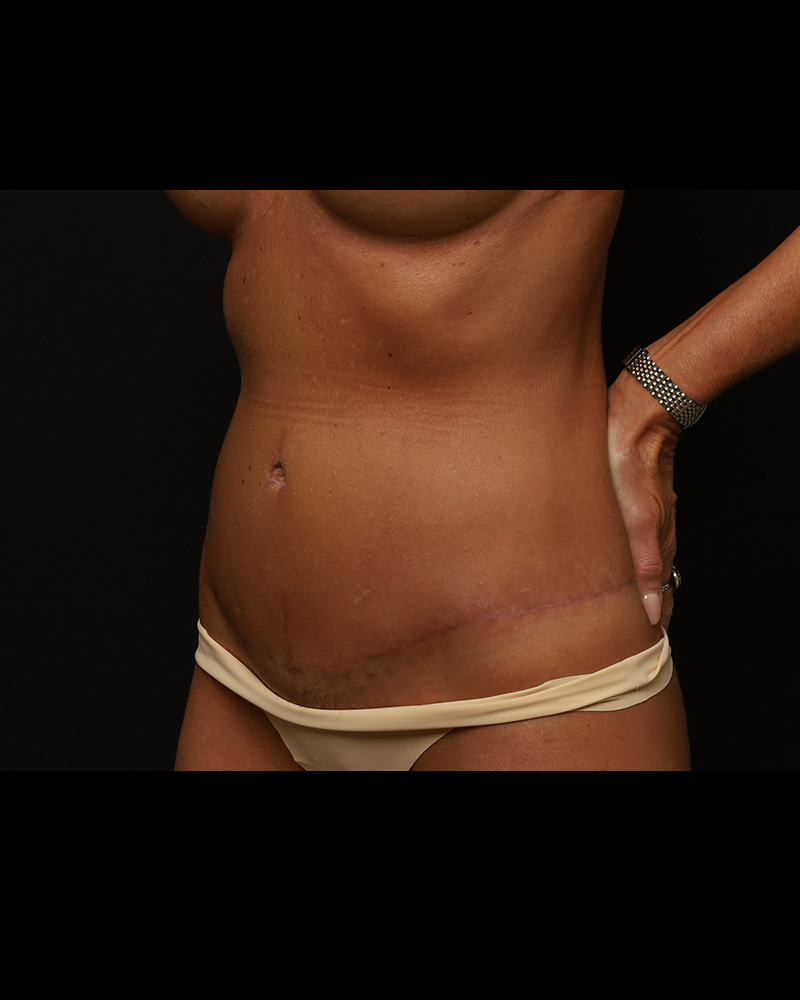 Tummy Tuck Before and After 03