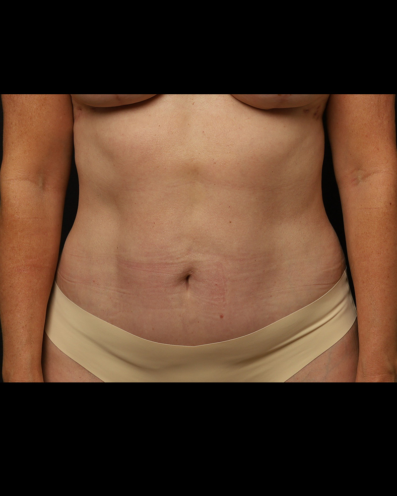 Tummy Tuck Before and After 07