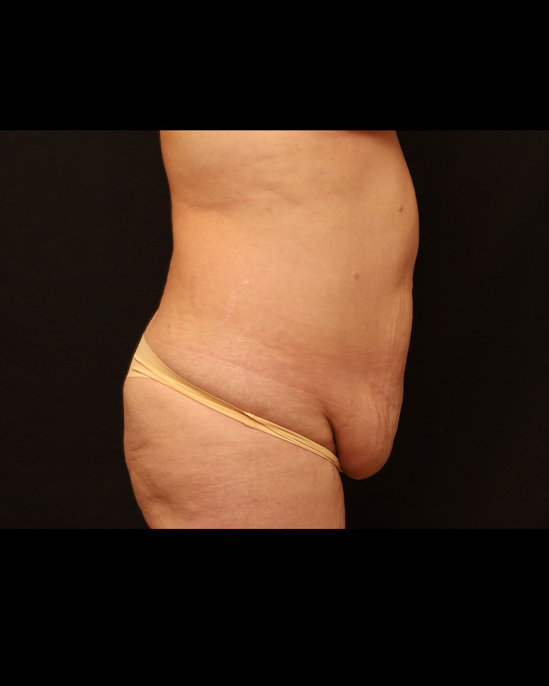 Tummy Tuck Before and After 04