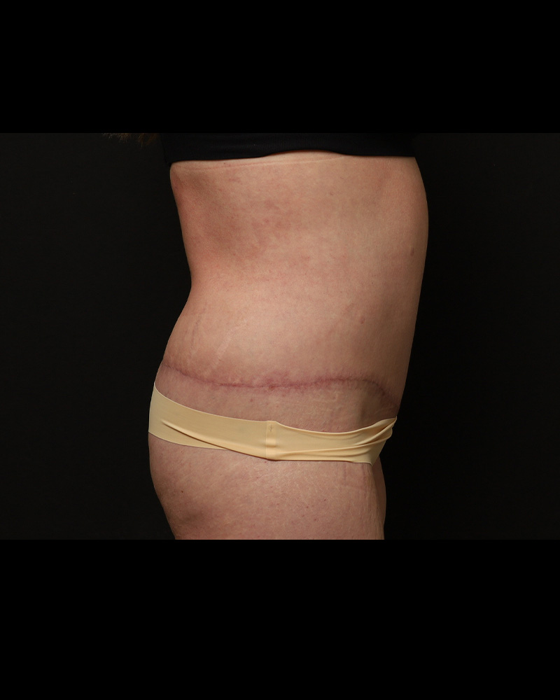 Tummy Tuck Before and After 04