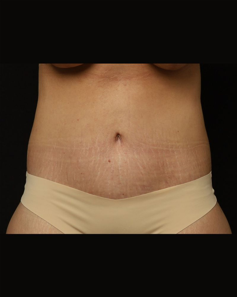 Tummy Tuck Before and After 07