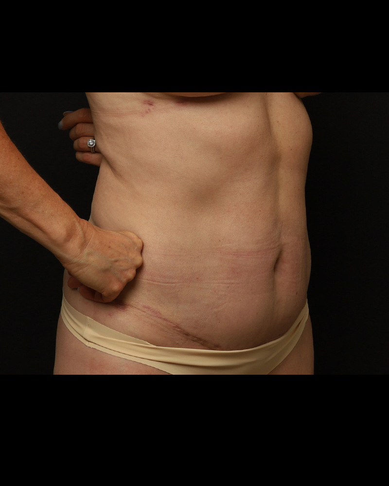 Tummy Tuck Before and After 05